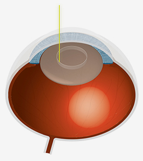 Zunächst wird die Linsenkapsel mit dem Laser exakt kreisrund eröffnet.