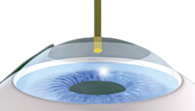 Die Hornhaut erhält durch einen Excimer-Laser eine  präzise multifokale Oberfläche .