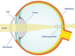 hornhautverkrümmung, astigmatismus