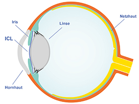 Wo liegt die ICL im Auge? Die ICL liegt deshalb so stabil, weil sie in der Hinterkammer des Auges liegt, also zwischen der Iris und der natürlichen Linse. 