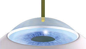 Abtrag des Epithels Die oberflächliche Zellschicht wird direkt mit dem Excimerlaser abgetragen. Im Vergleich zu den alten Methoden ist ein mechanischer Abtrag (LASEK) oder mit Alkohol (PRK) nicht mehr nötig. 