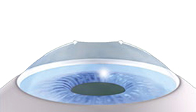 Nachsorge Die Oberfläche wird mit einer Kontaktlinse geschützt, bis die oberflächliche Zellschicht nachgewachsen ist.