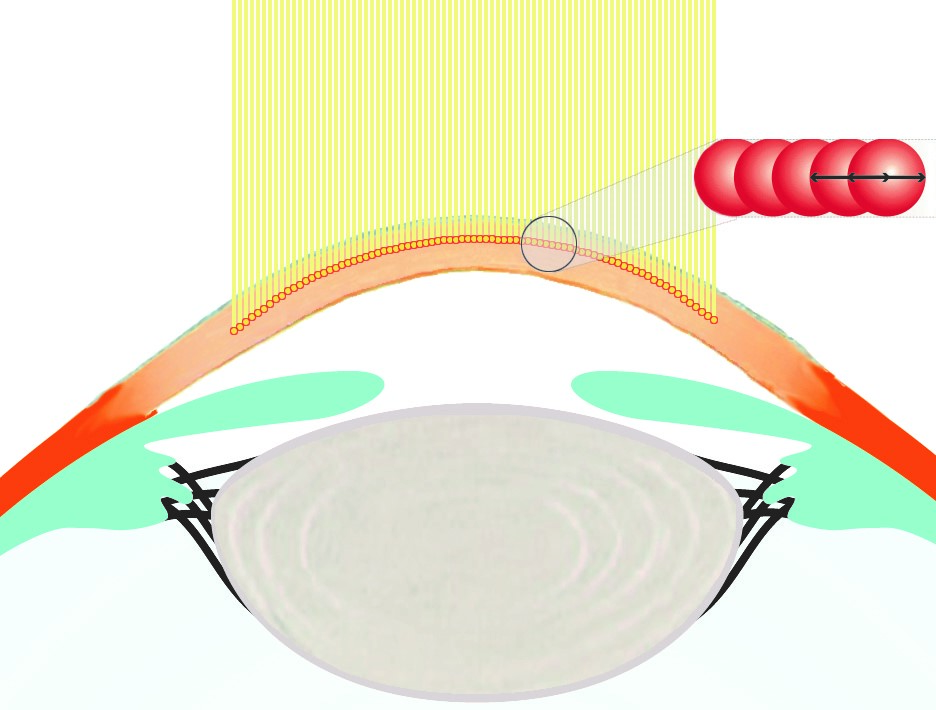 Femtosekundenlaser Zunächst wird eine sehr dünne Hornhautlamelle (Flap) mit dem Femtosekundenlaser geformt.