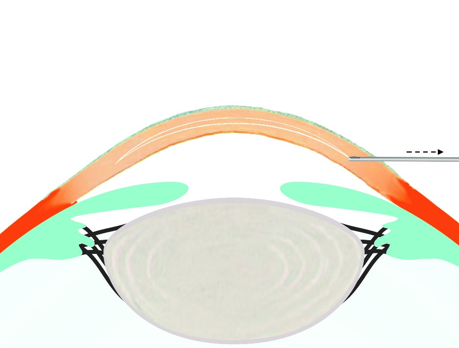 Excimer-Behandlung Die Hornhaut wird durch einen Excimer-Laser präzise entsprechend Ihrer Fehlsichtigkeit moduliert. 