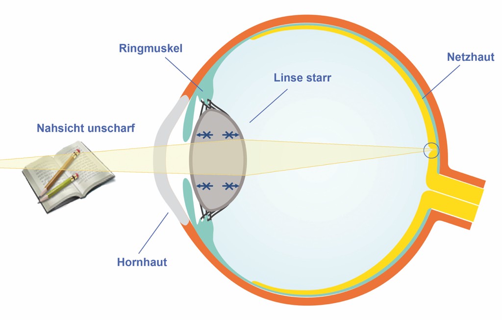 Querschnitt Auge bei Alterssichtigkeit