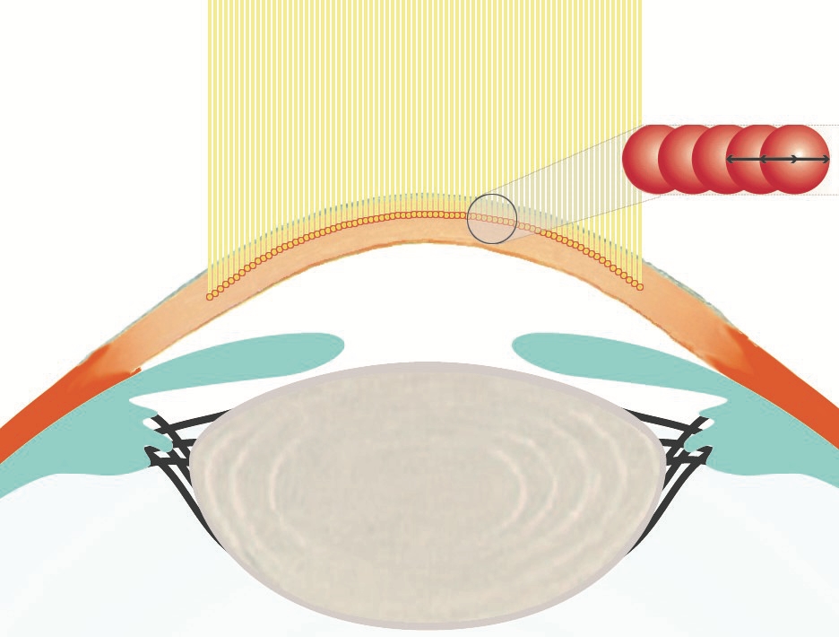Femtosekundenlaser Femtosekundenlaser