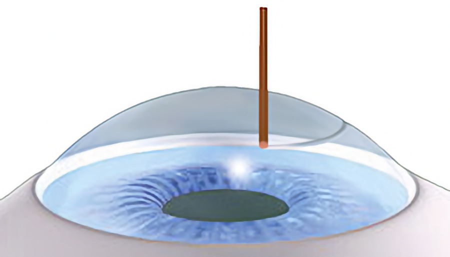 Femtosekundenlaser Femtosekundenlaser