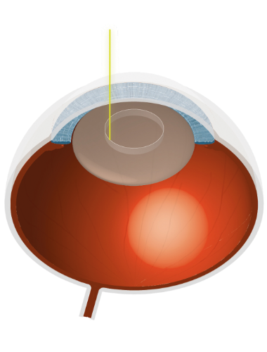 Grauer Star Illustration Auge