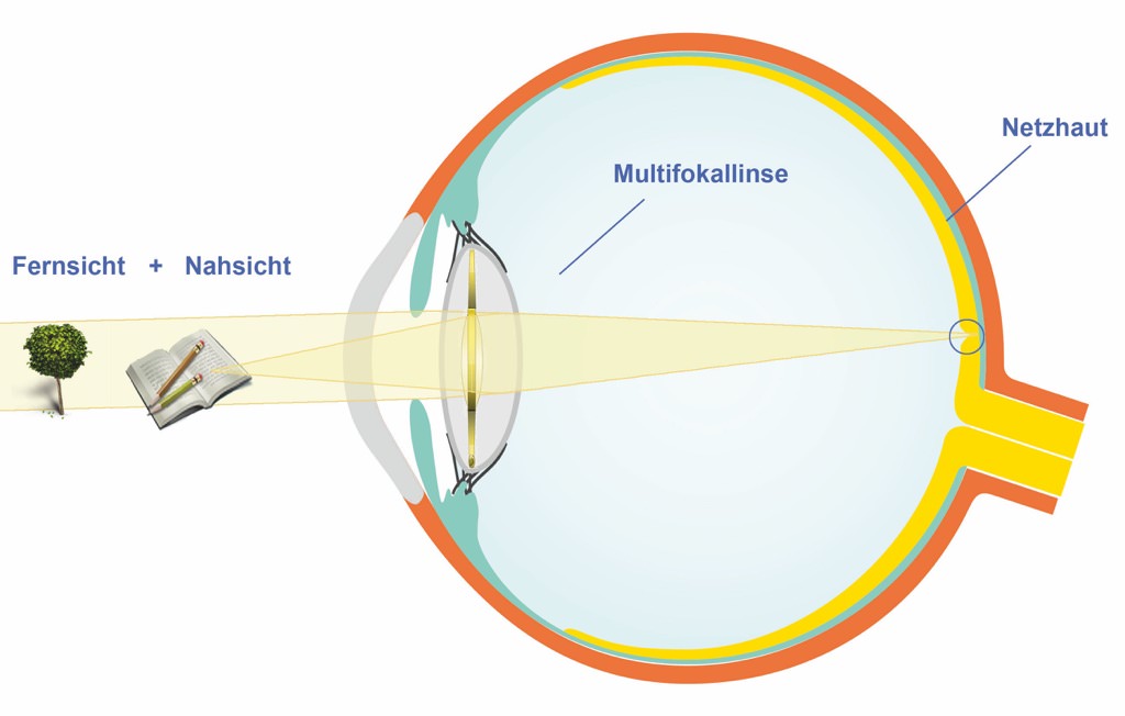 Querschnitt Auge mit Multifokallinse